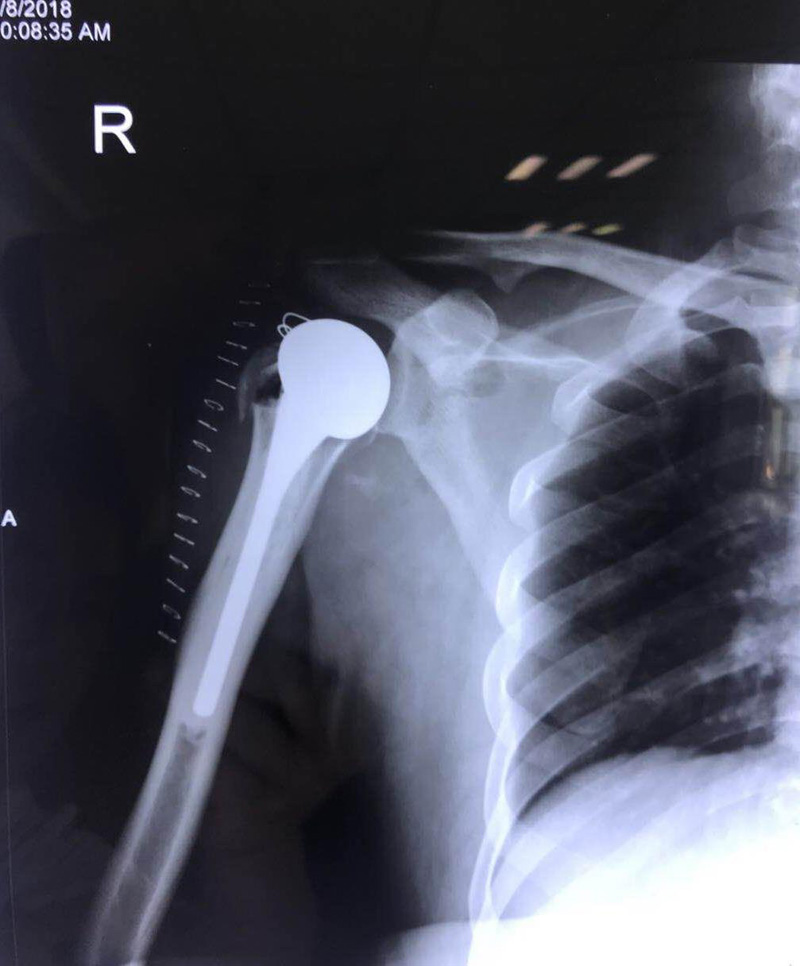 携生医疗右侧肱骨头置换手术后X光片 携生医疗右侧肱骨头置换手术后X光片