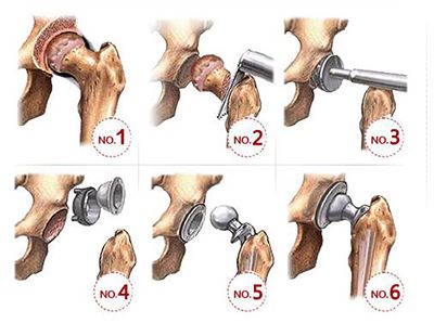 什么才是膝关节置换手术——携生医疗